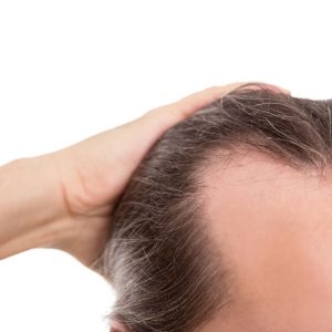 PRF Haartherapie Haarausfall